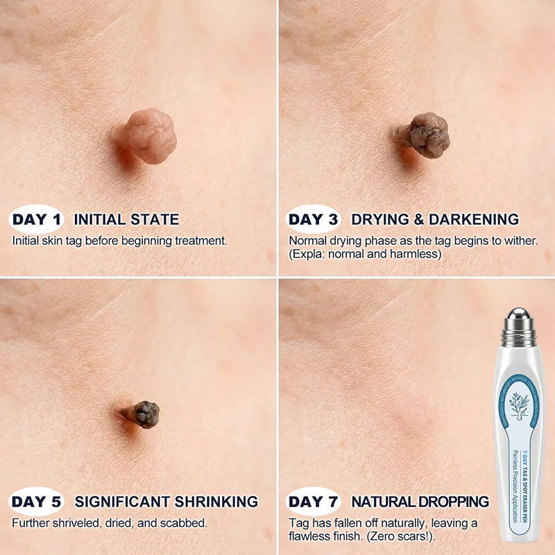 Wart Removal Rollerball Serum